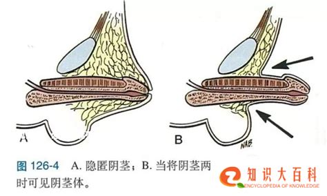 阴茎龟头|阴茎健康：识别并预防问题